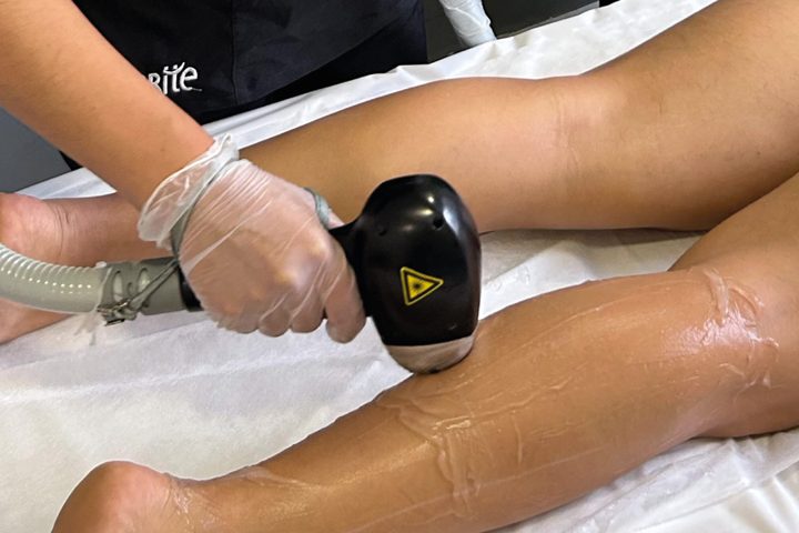 Laser hair removal